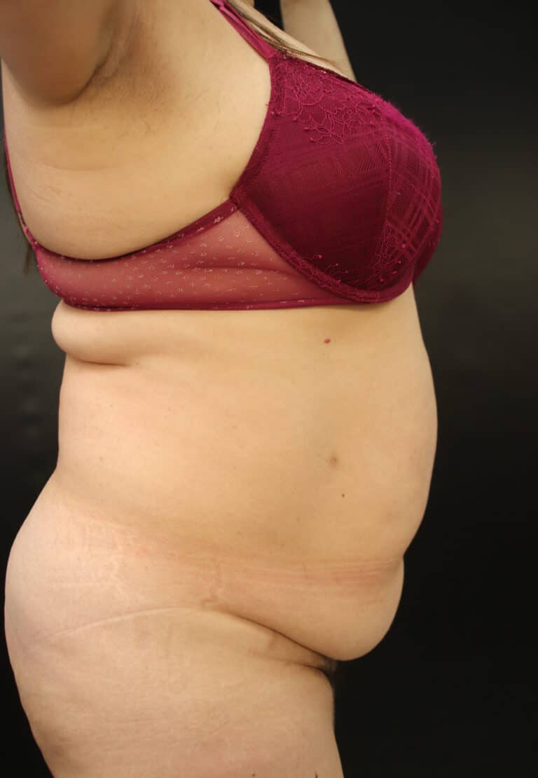 Before Image: Abdominoplasty - right-side