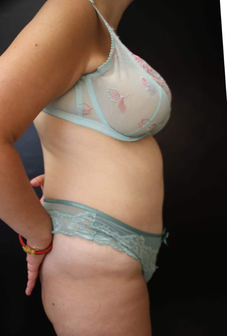 After Image: Abdominoplasty - right-side