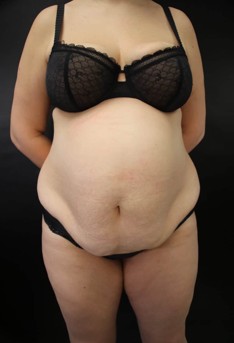 Before Image: Abdominoplasty - front
