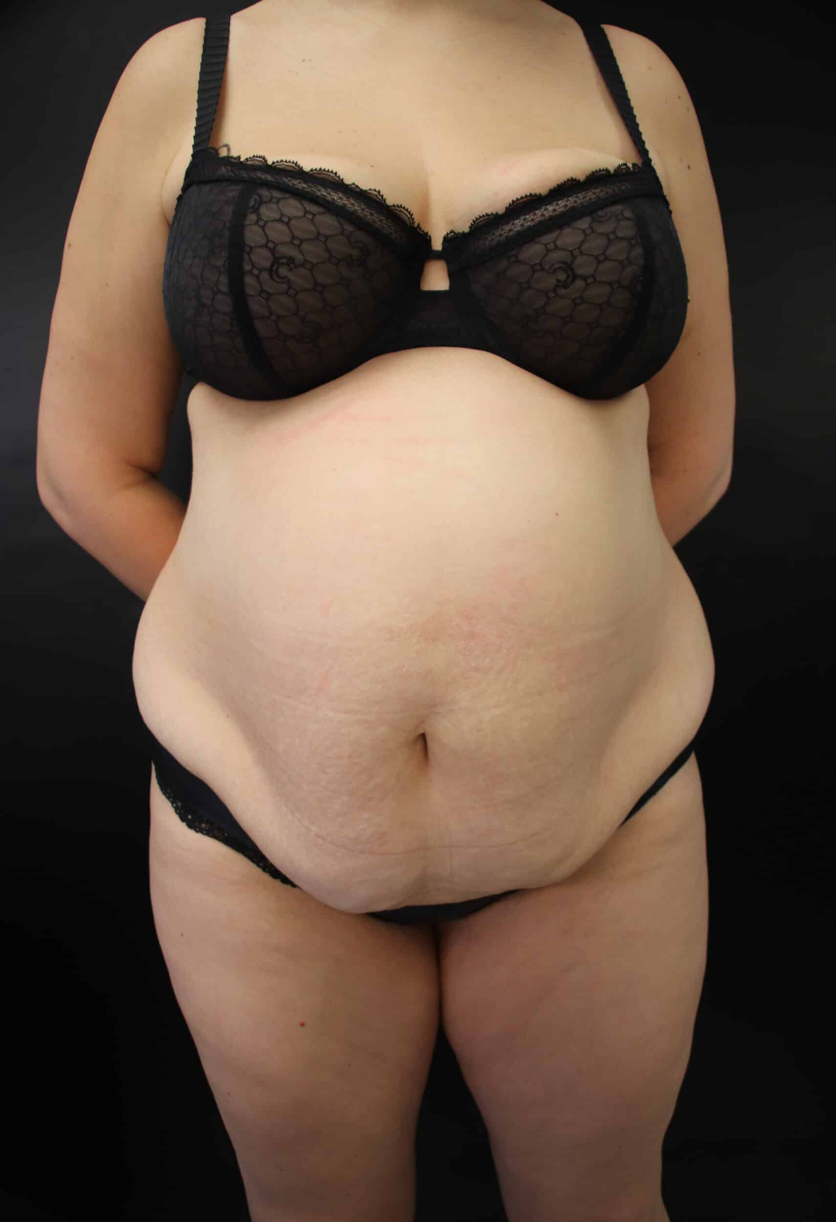 Before Image: Abdominoplasty - front