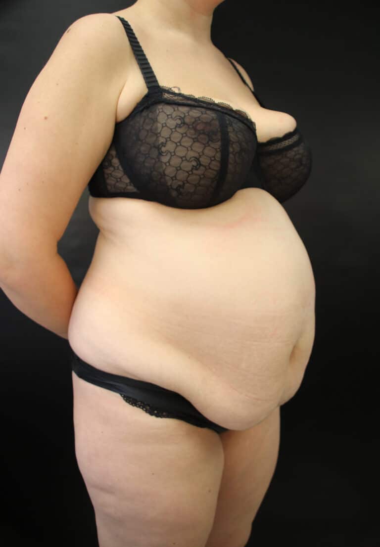 Before Image: Abdominoplasty - right-front-oblique