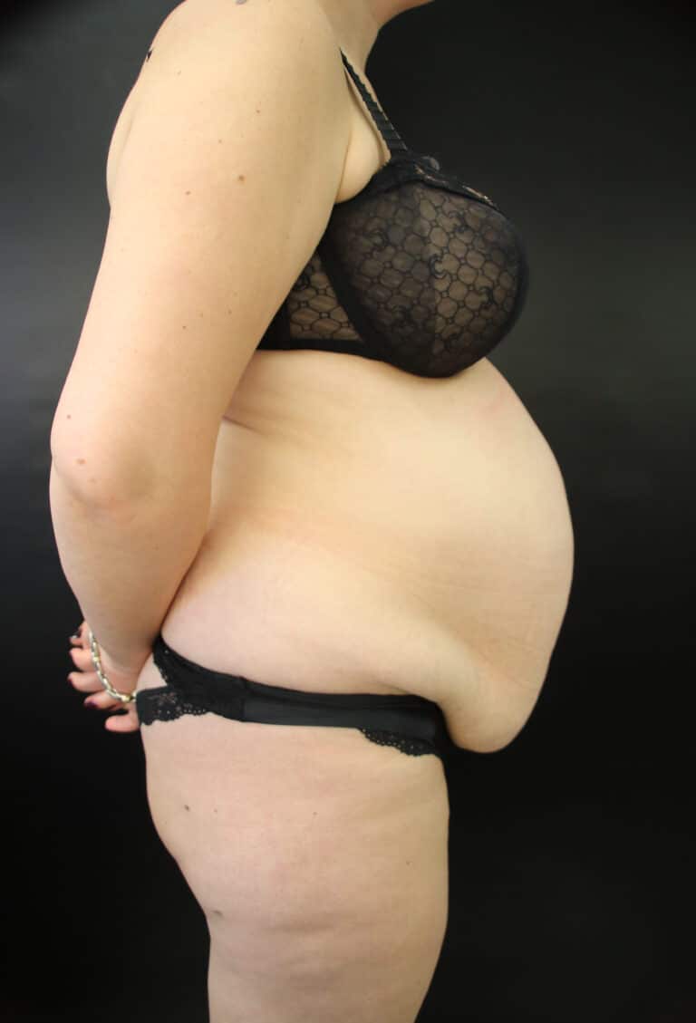 Before Image: Abdominoplasty - right-side