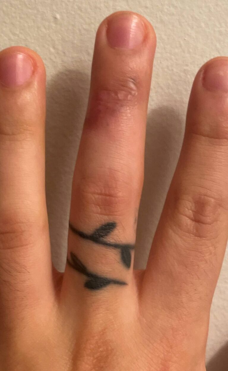 After Image: Tattoo Removal - front