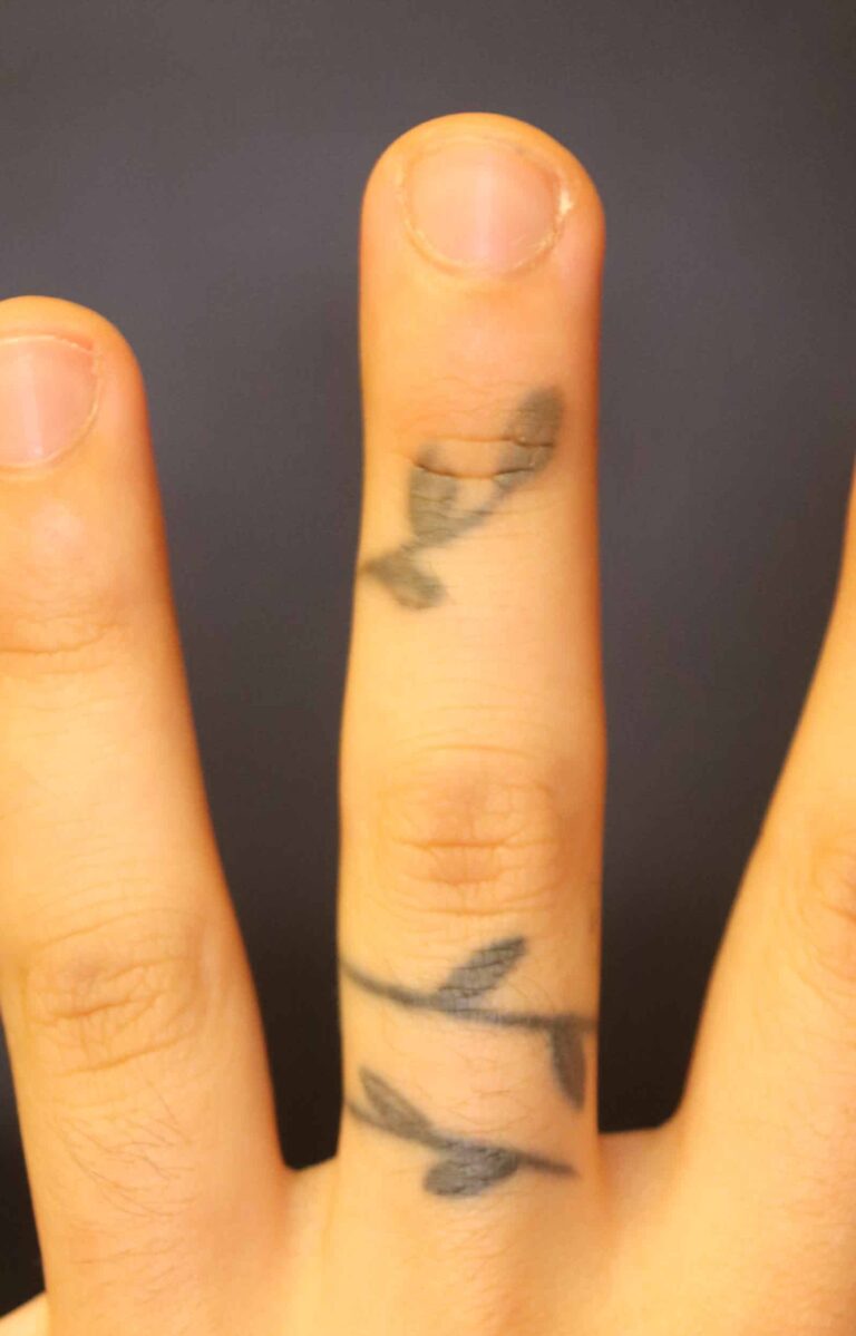 Before Image: Tattoo Removal - front
