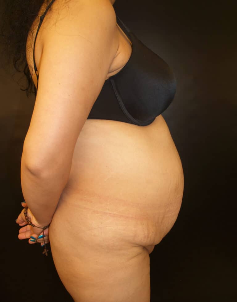 Before Image: Abdominoplasty - right-side
