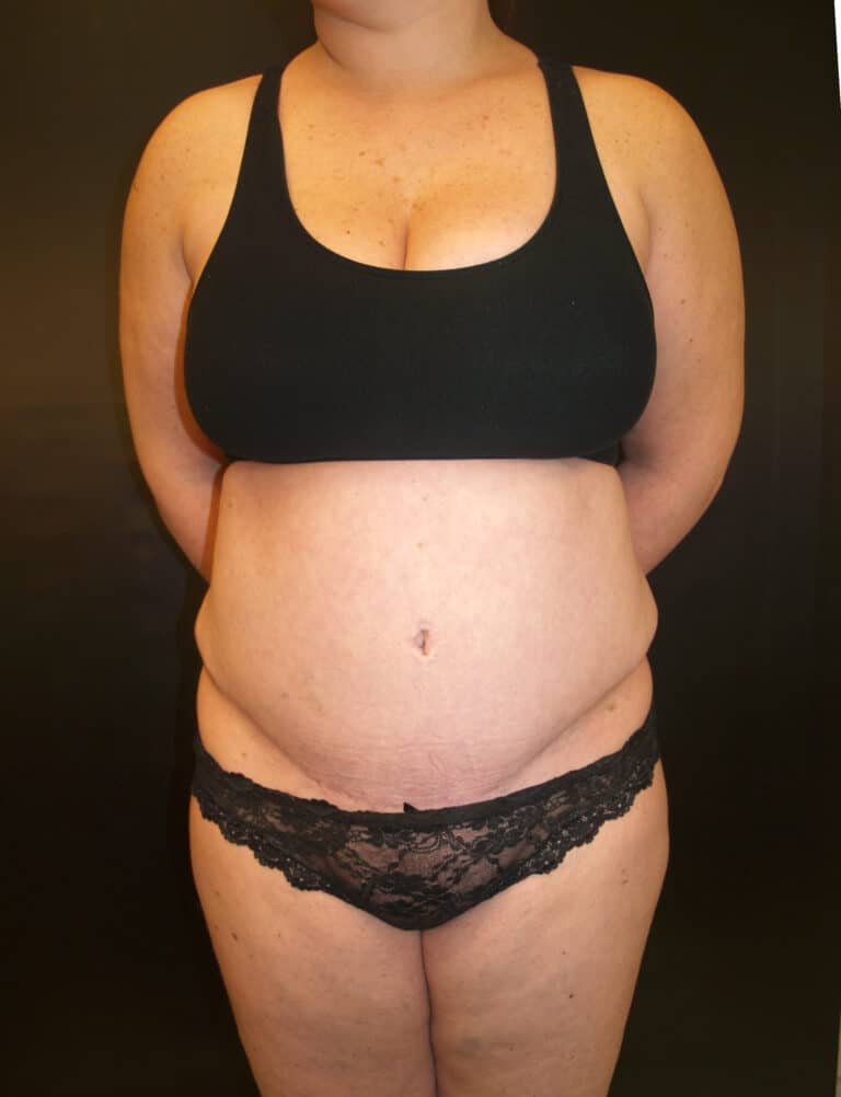 After Image: Abdominoplasty - front
