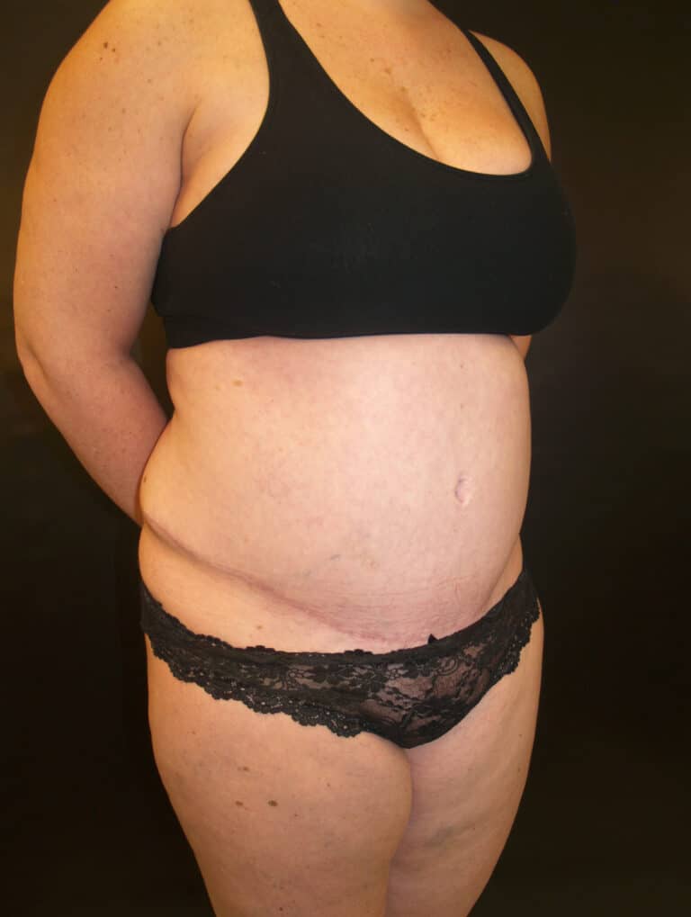 After Image: Abdominoplasty - right-front-oblique