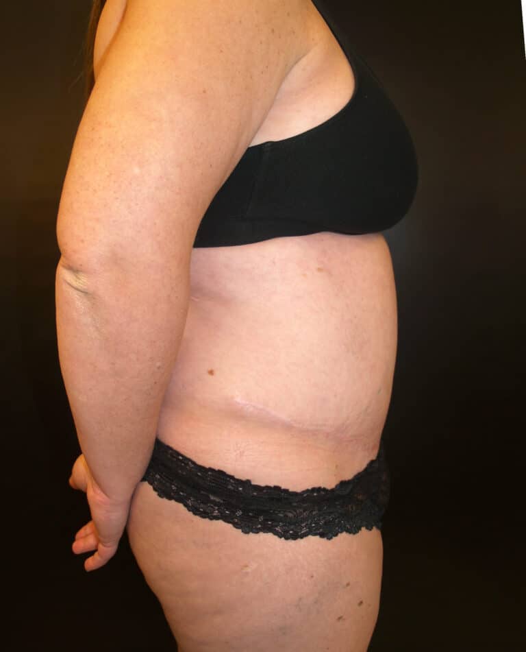 After Image: Abdominoplasty - right-side