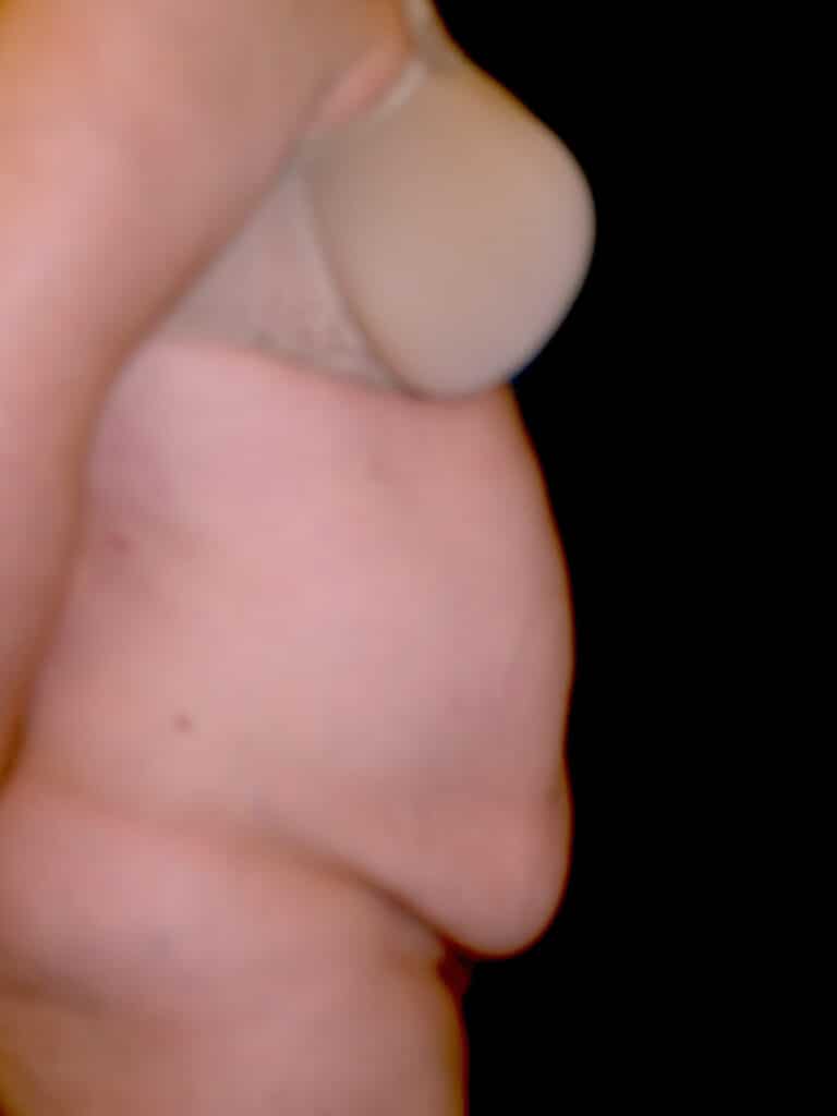 Before Image: Abdominoplasty - right-side
