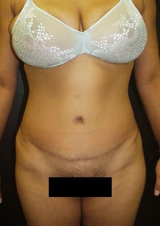 Abdominoplasty – Case 1