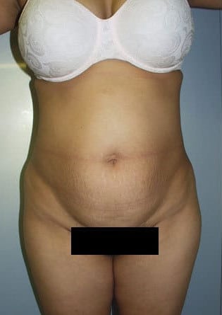 Abdominoplasty – Case 1