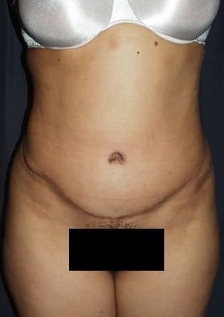 Abdominoplasty – Case 2