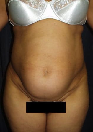 Abdominoplasty – Case 2