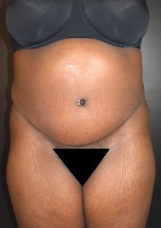 Abdominoplasty – Case 3