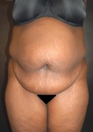 Abdominoplasty – Case 3