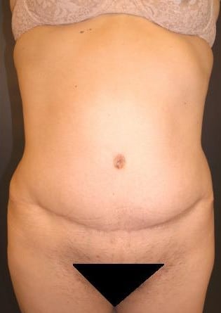 Abdominoplasty – Case 4