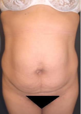 Abdominoplasty – Case 4