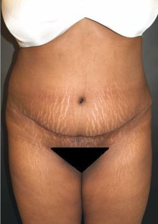 Abdominoplasty – Case 5