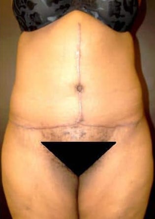 Abdominoplasty – Case 6