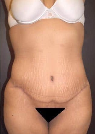 Abdominoplasty – Case 7