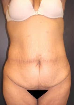 Abdominoplasty – Case 7