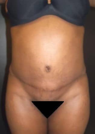 Abdominoplasty – Case 8