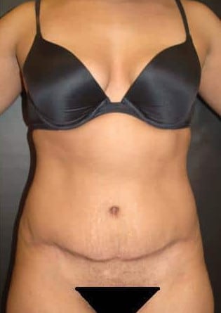 Abdominoplasty – Case 9