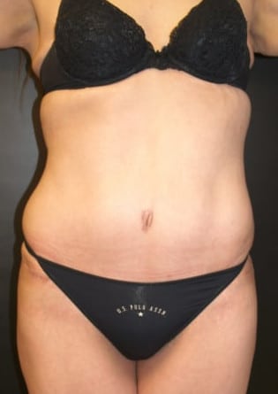 Abdominoplasty – Case 10