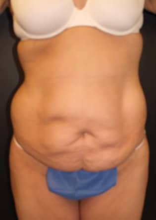 Abdominoplasty – Case 10