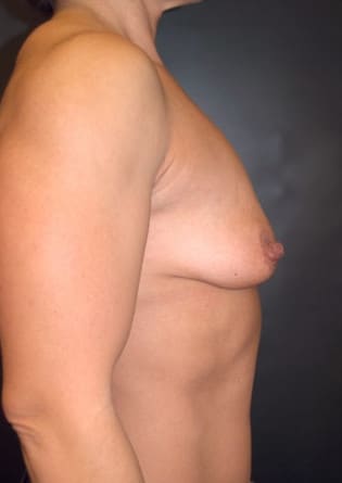 Breast Augmentation – Case 2