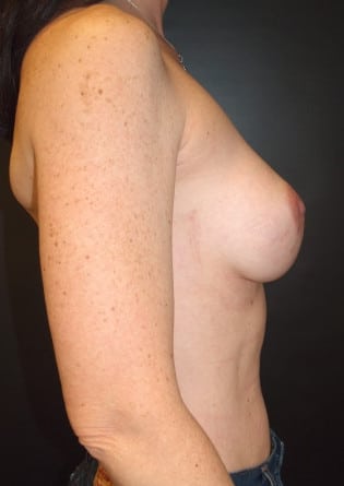 Breast Augmentation – Case 4
