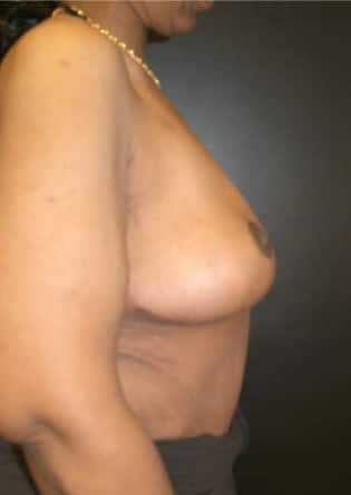 Breast Lift – Case 1