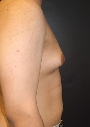 Male Breast Reduction – Case 2