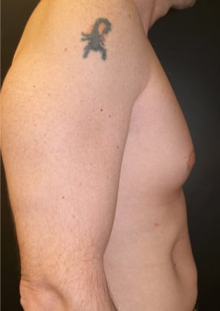 Male Breast Reduction – Case 3