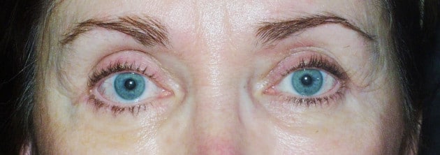 Blepharoplasty – Case 1 2024