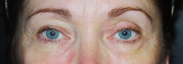 Blepharoplasty – Case 1 2024