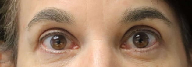 Blepharoplasty – Case 2 2024