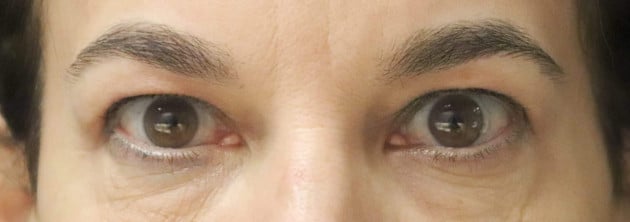 Blepharoplasty – Case 2 2024