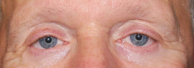 Blepharoplasty – Case 3 2024
