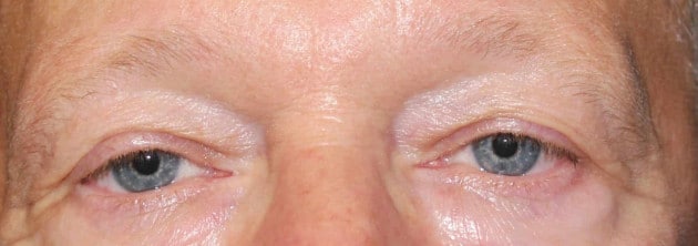 Blepharoplasty – Case 3 2024