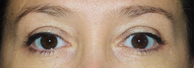 Blepharoplasty – Case 4 2024