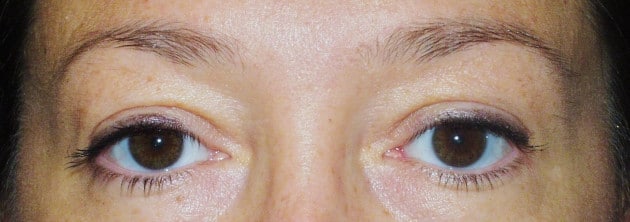Blepharoplasty – Case 4 2024