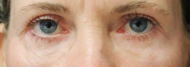 Blepharoplasty – Case 5 2024