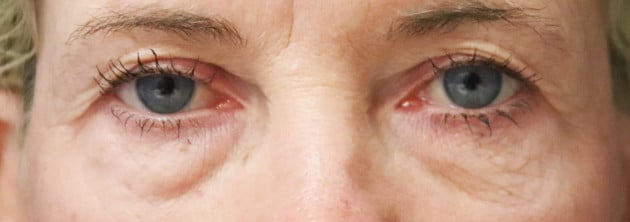 Blepharoplasty – Case 5 2024