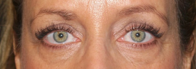Blepharoplasty – Case 6 2024