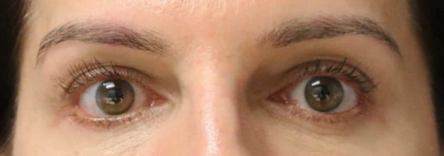 Blepharoplasty – Case 7 2024
