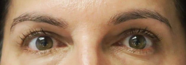 Blepharoplasty – Case 7 2024