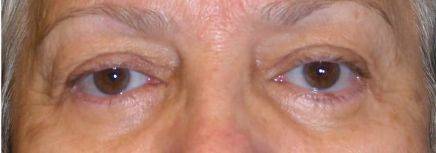 Blepharoplasty – Case 8 2024
