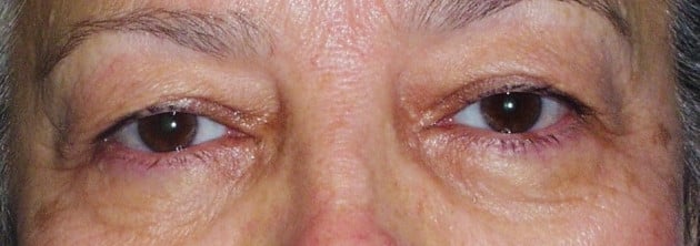 Blepharoplasty – Case 8 2024
