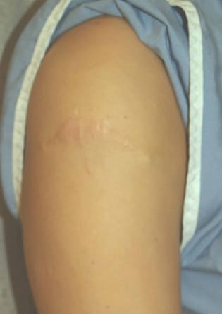 Tattoo Removal – Case 1 2024